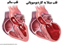 Cardiomyopathy.jpg