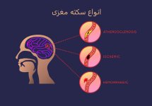 brain-stroke2.jpg brain-stroke2.jpg