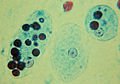 120px-Trophozoites_of_Entamoeba_histolytica_with_ingested_erythrocytes.JPG