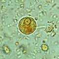 120px-Ehistdisp_cyst_wtmt.jpg