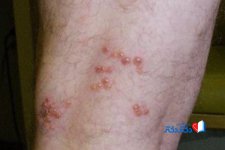 Wound-shingles.jpg