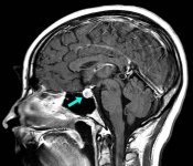 Makayla_sagittal_preop.jpg Makayla_sagittal_preop.jpg