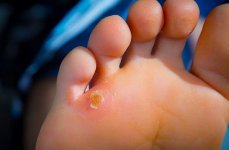 میخچه-پا-چه-علائمی-دارد؟-درمان-با-کفش-و-کفی-طبی-و-جراحی-min.jpg میخچه-پا-چه-علائمی-دارد؟-درمان-با-کفش-و-کفی-طبی-و-جراحی-min.jpg