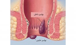 بواسیر.jpg