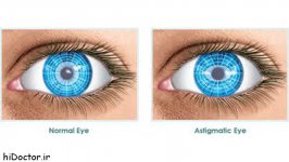 Astigmatism.jpg