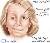 bells-palsy-signs.jpg
