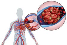 Pulmonary-embolism-768x512.jpg