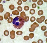 Eosinophil_blood_smear.JPG