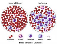 Leukemia.jpg