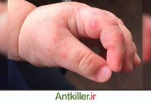 ant-bites.jpg