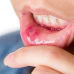 mouth-sores-150x150.jpg